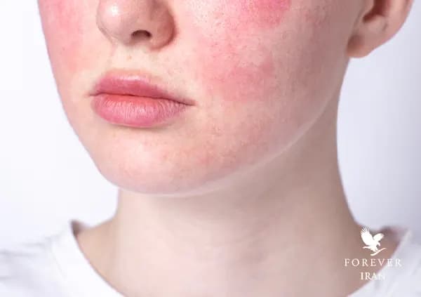 حساسیت پوستی